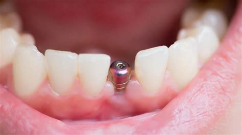 implant diş ölçüsü nasıl alınır